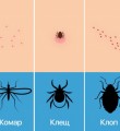 Укусы клещей Укусы клещей